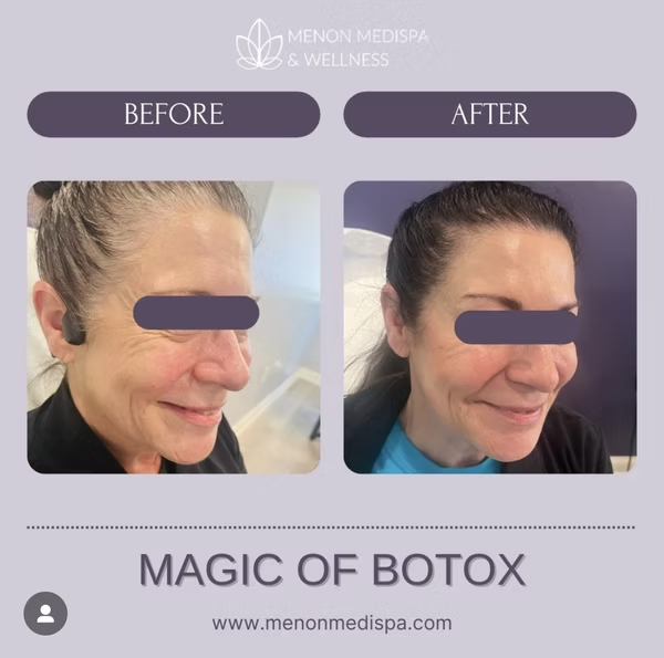 Before and after Botox - Magic of Botox results